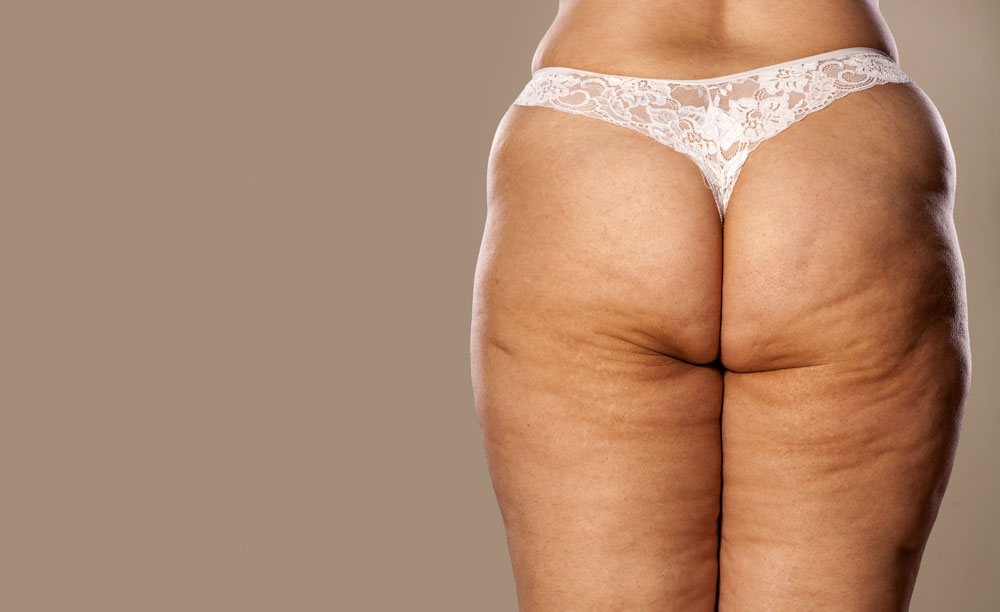cellulite